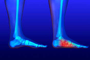 Flat feet and fallen arches treatment in the Kings County, NY: Brooklyn (Midwood, Bay Ridge, Sunset Park, Bushwick, Park Slope, East New York, Williamsburg, Brighton Beach, Brownsville, Greenpoint, Brooklyn Heights, Kensington), Richmond County, NY: St. George, Midland Beach, and Queens County, NY: Elmhurst, Maspeth, Forest Hills areas