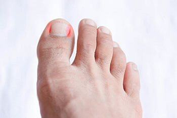 Ingrown toenails treatment in the Kings County, NY: Brooklyn (Midwood, Bay Ridge, Sunset Park, Bushwick, Park Slope, East New York, Williamsburg, Brighton Beach, Brownsville, Greenpoint, Brooklyn Heights, Kensington), Richmond County, NY: St. George, Midland Beach, and Queens County, NY: Elmhurst, Maspeth, Forest Hills areas