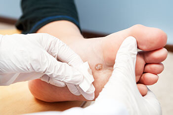 Plantar Warts Treatment in the Kings County, NY: Brooklyn (Midwood, Bay Ridge, Sunset Park, Bushwick, Park Slope, East New York, Williamsburg, Brighton Beach, Brownsville, Greenpoint, Brooklyn Heights, Kensington), Richmond County, NY: St. George, Midland Beach, and Queens County, NY: Elmhurst, Maspeth, Forest Hills areas