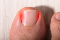 What Causes an Ingrown Toenail?