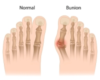Understanding Bunions and the Importance of Podiatric Care